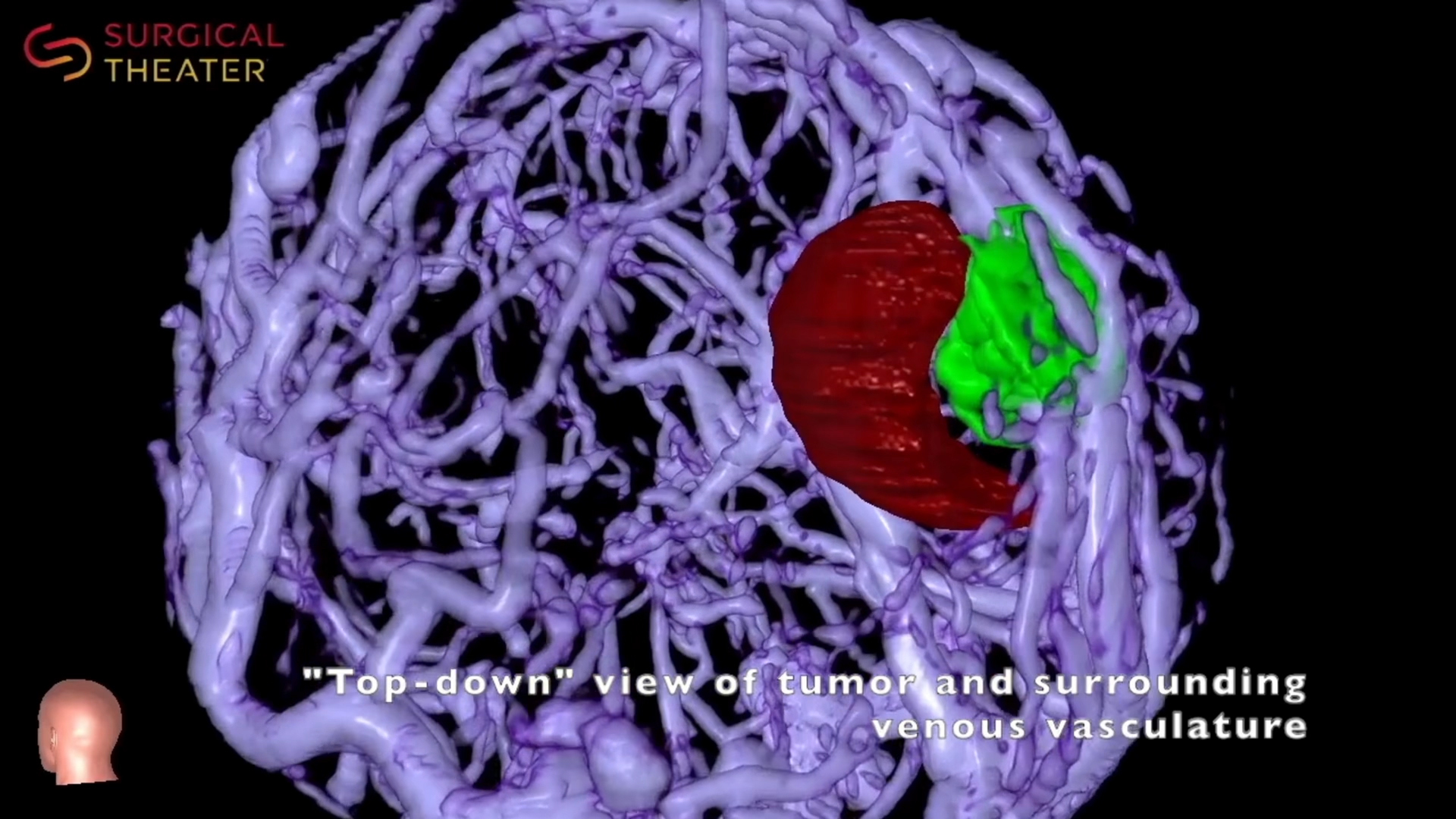 Animation showing a 3D visualization of a tumor