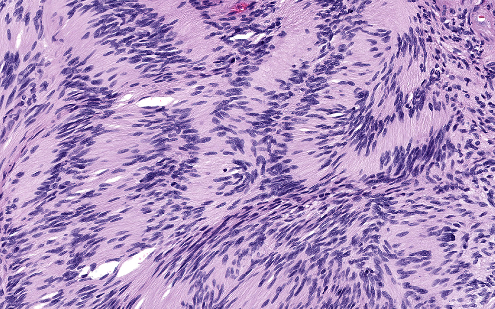 Microscopy image showing the histology of a schwannoma
