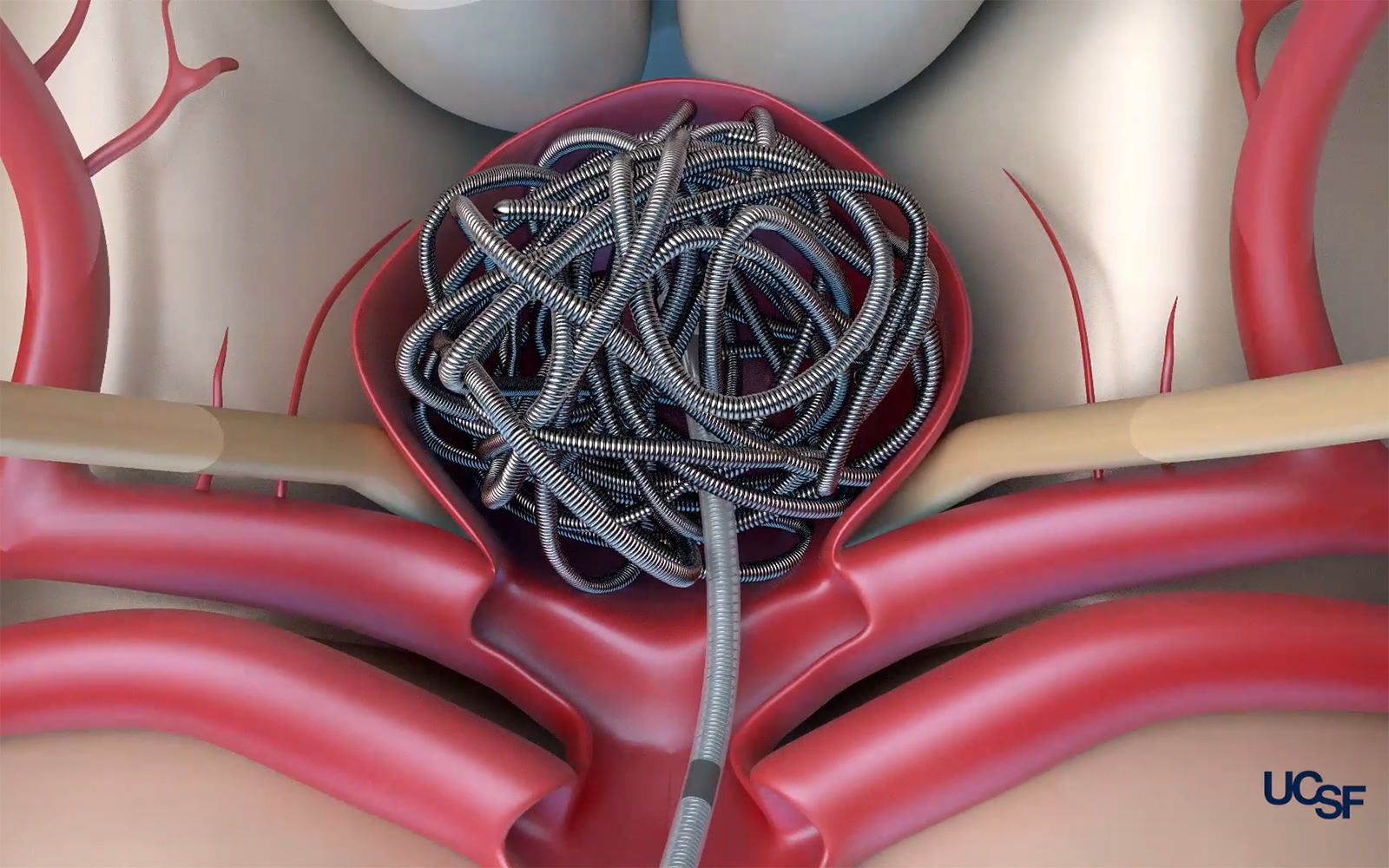 Illustration showing end-vascular coiling procedure