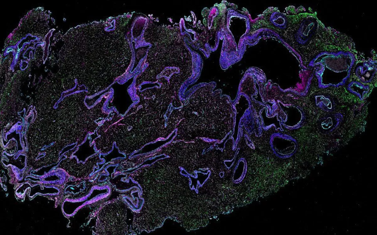 Microscopy image showing that blood vessels in an AVM (blue) contain patches of immune cells (green) that destabilize the vasculature, potentialy leading to stroke. Image by Jayden Ross and Ethan Winkler
