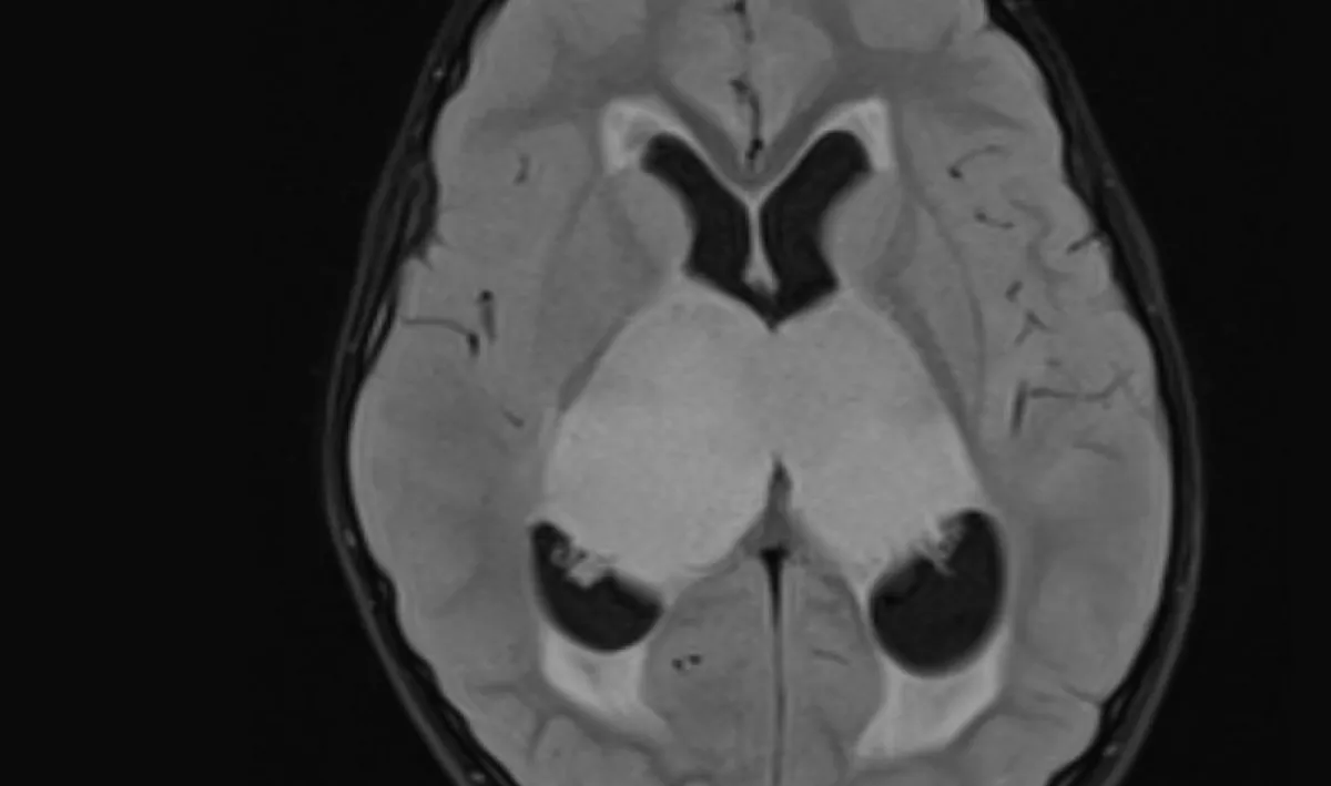 pediatric bithalamic glioma