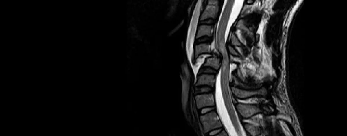 cervical SCI