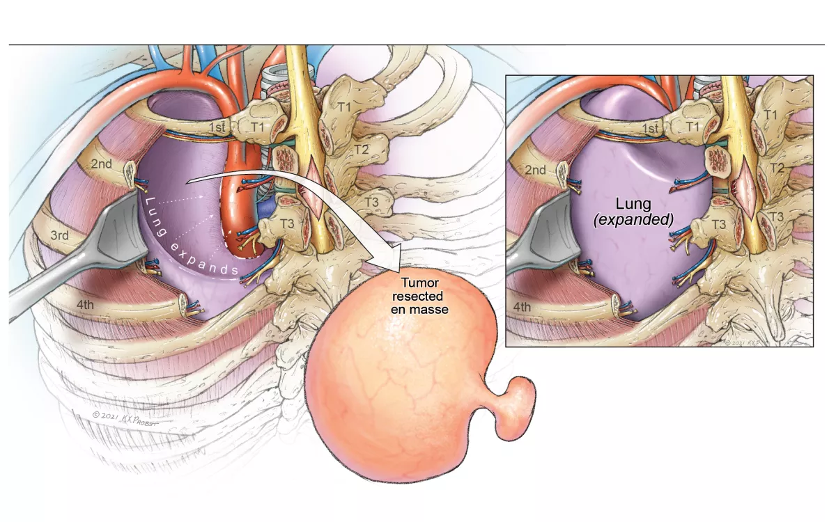 Dumbell schwannoma