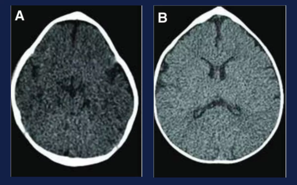MRI scan of brain 