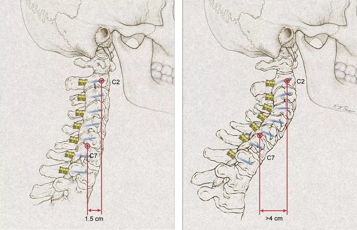 Cervical Deformity Surgery Guide