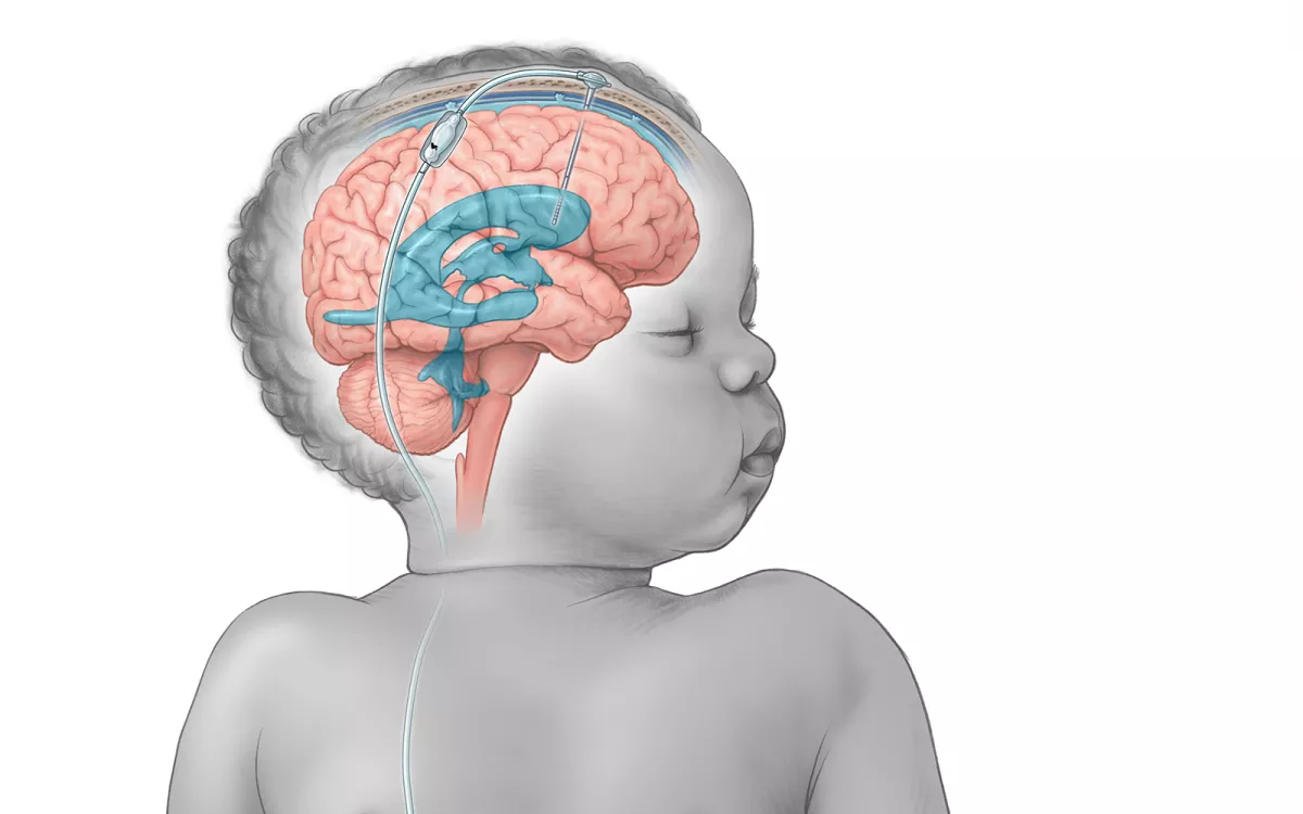 Illustration showing an infant with a shunt to treat hydrocephalus