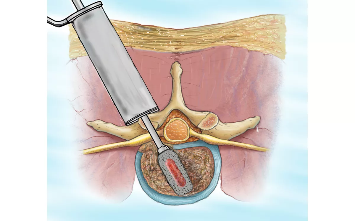 Illustration of an MI-TLIF