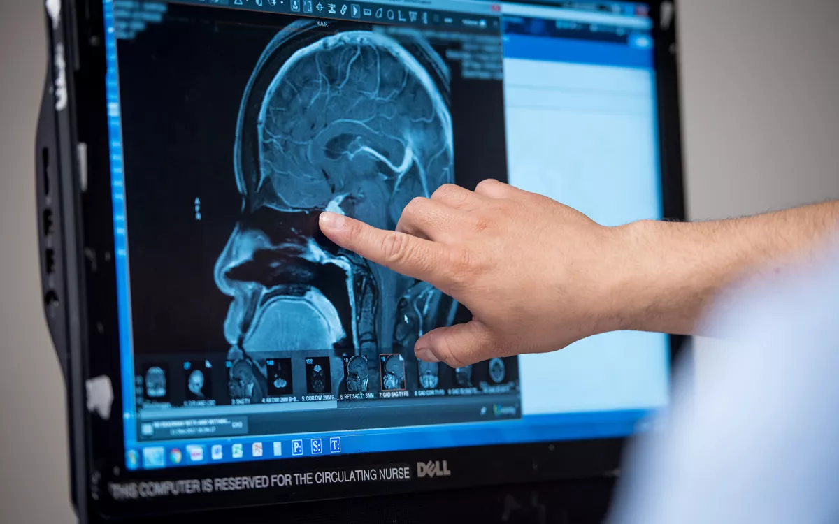 Computer showing an MRI of a pituitary adenoma.