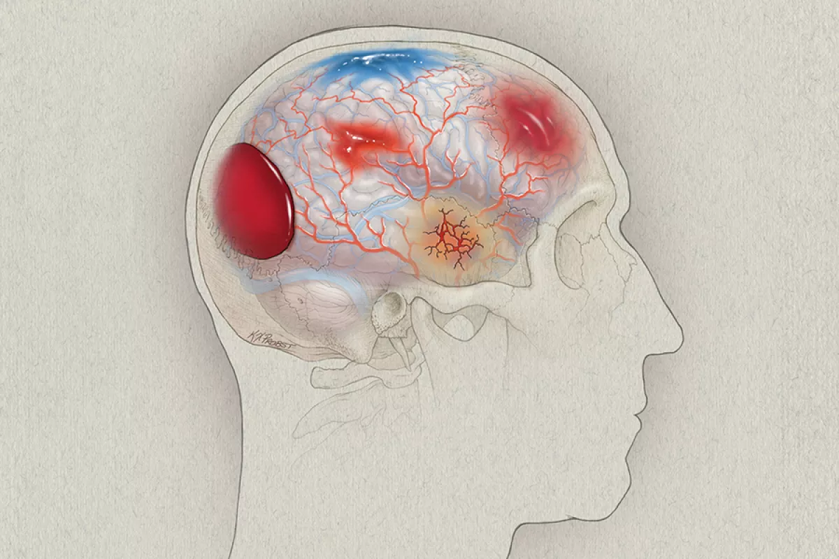 Illustration depicting traumatic brain injuries.