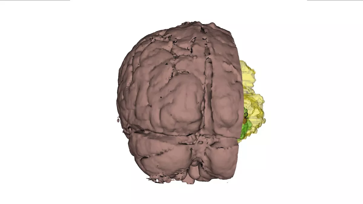 3D representation of an individual patient's tumor.