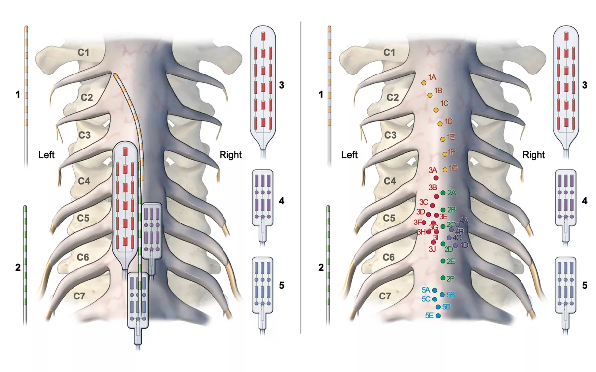 Illustration of the cervical spinal cord showing the position of the epidural electrode leads (left) and a map of all the contacts used in the analysis (right).