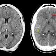 Side-by-side CT scans of traumatic brain injuries.