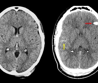 Side-by-side CT scans of traumatic brain injuries.