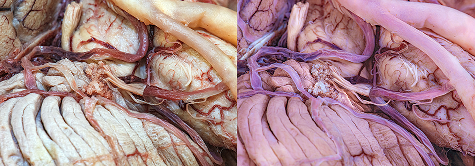 Side-by-side comparison of two images of the brainstem and cerebellum showing that UV fluorescence photography techniques make structures appear almost luminous, and the visibility of various structures is more clear.