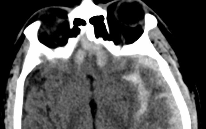 MRI of a patient with a traumatic brain injury