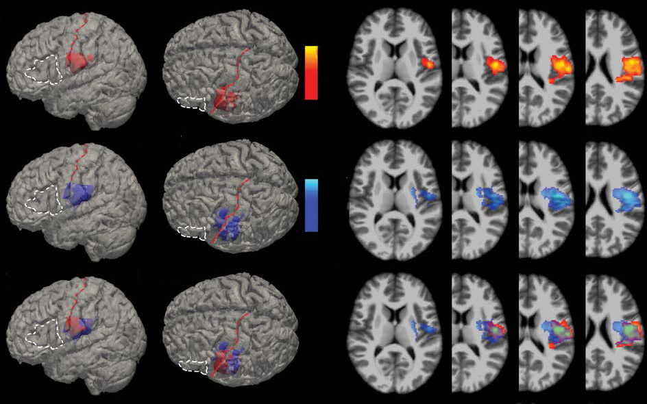 3D reconstructions of the voxels (red) most highly associated with Broca’s aphasia (p < 0.001) overlaid on the MNI brain. For anatomical reference, the white dashed line outlines Broca’s area and the red dashed line lies over the central sulcus.