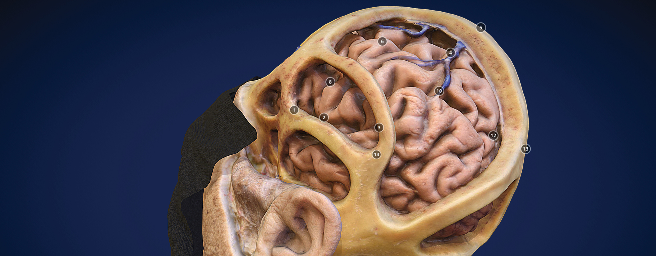 3D model of craniometric points (UCSF Skull Base Lab)
