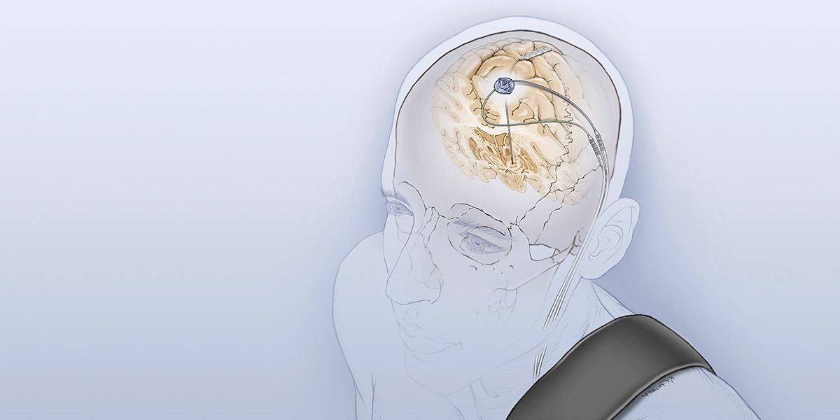 Illustration of deep brain stimulation device implanted in the brain