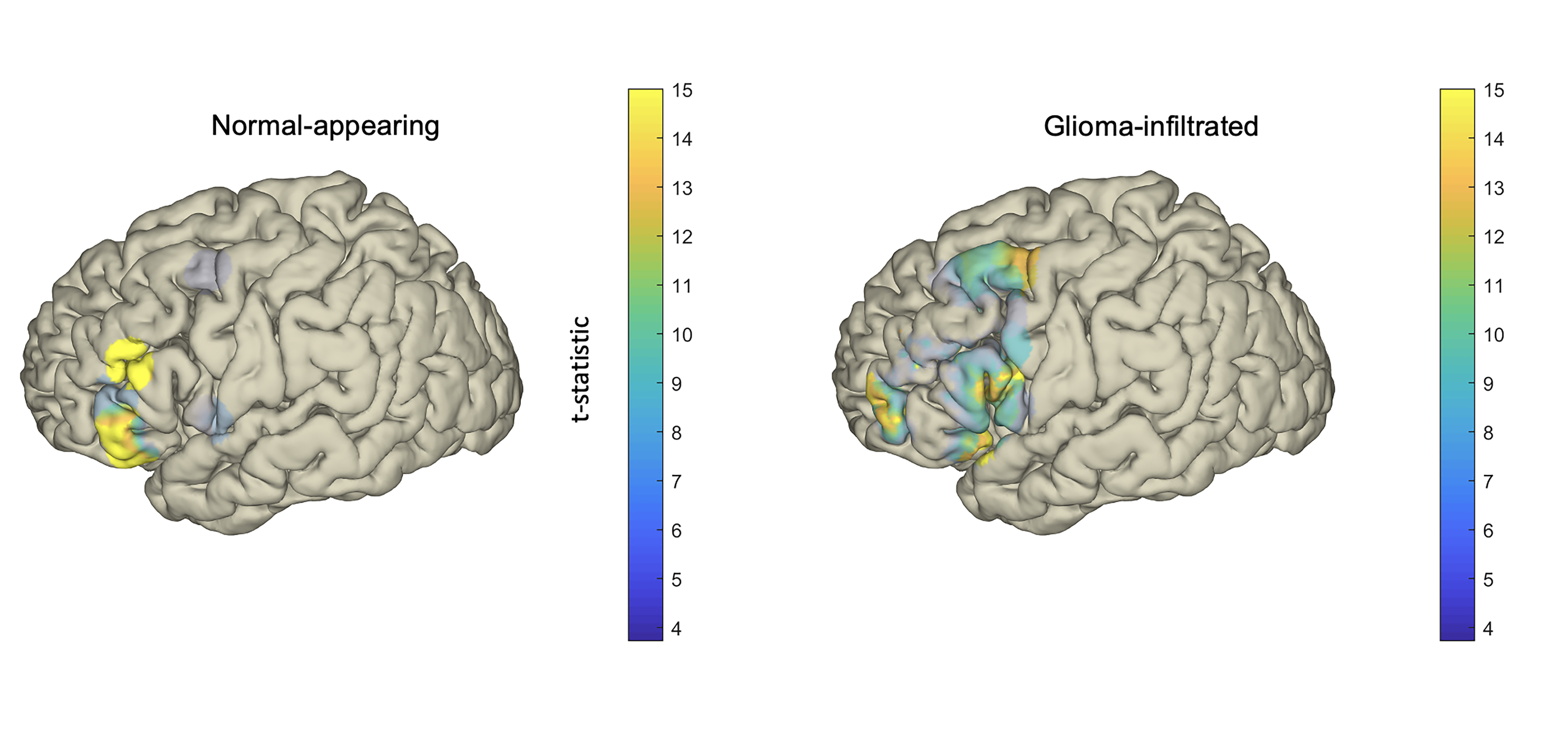 Model of glioma infiltration of speech cortex