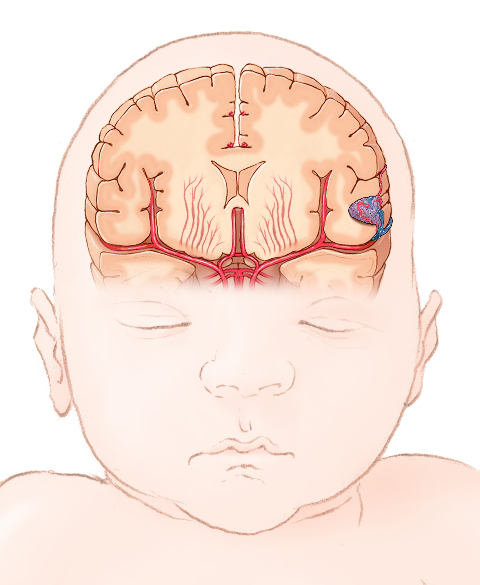 Illustration a child's brain with an AVM