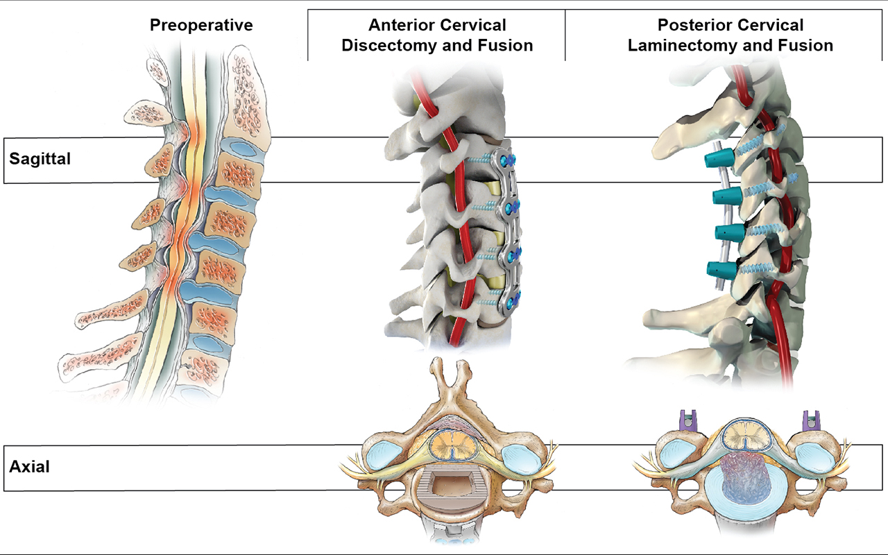 Illustration depicting ACDF and PCF