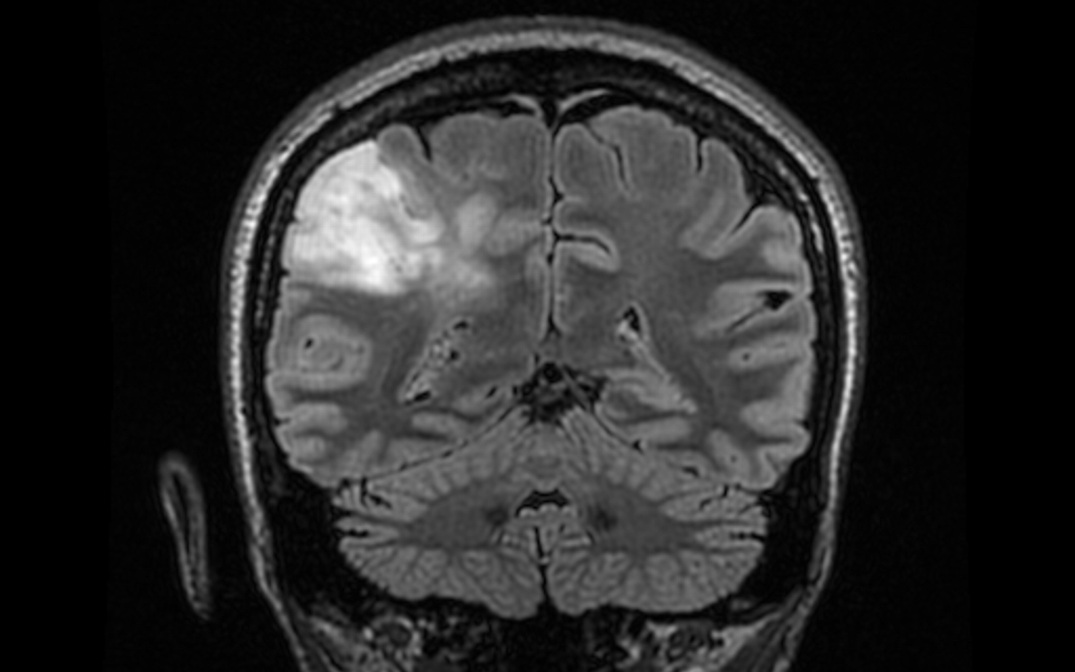 MRI showing a low-grade glioma