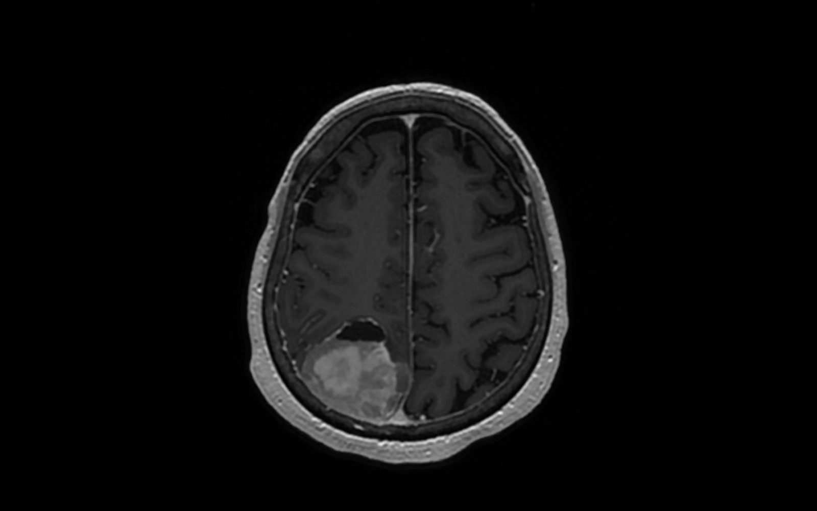 MRI scan showing a meningioma