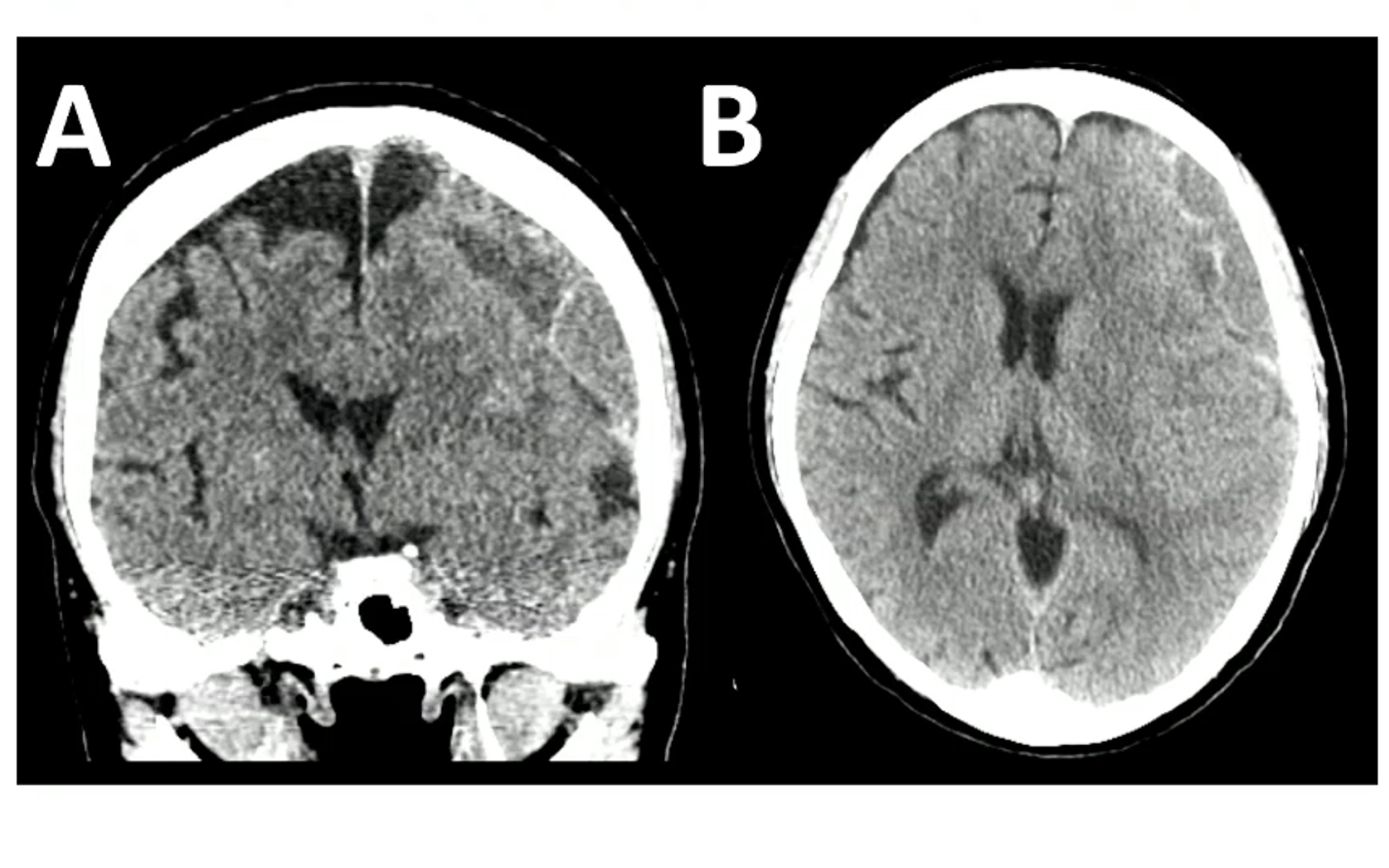 MRI scans showing coronal and horizontal views of a chronic subdural hematoma