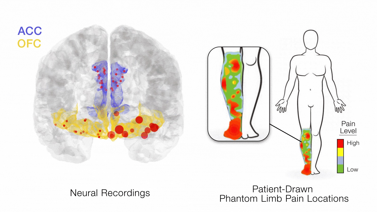 Increased signaling from the orbitofrontal cortexcorrelated with higher pain levels seen on a self-reported pain map from a patient with phantom limb pain