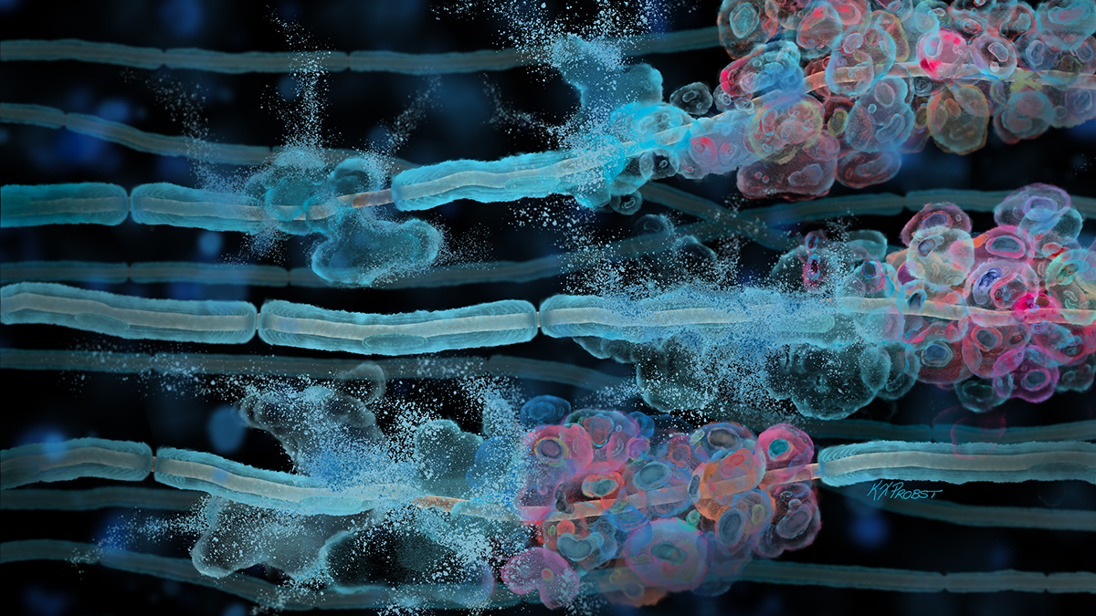 Illustration depicting tumors forming in Schwann cells, which normally make the myelin sheath that protects nerves.