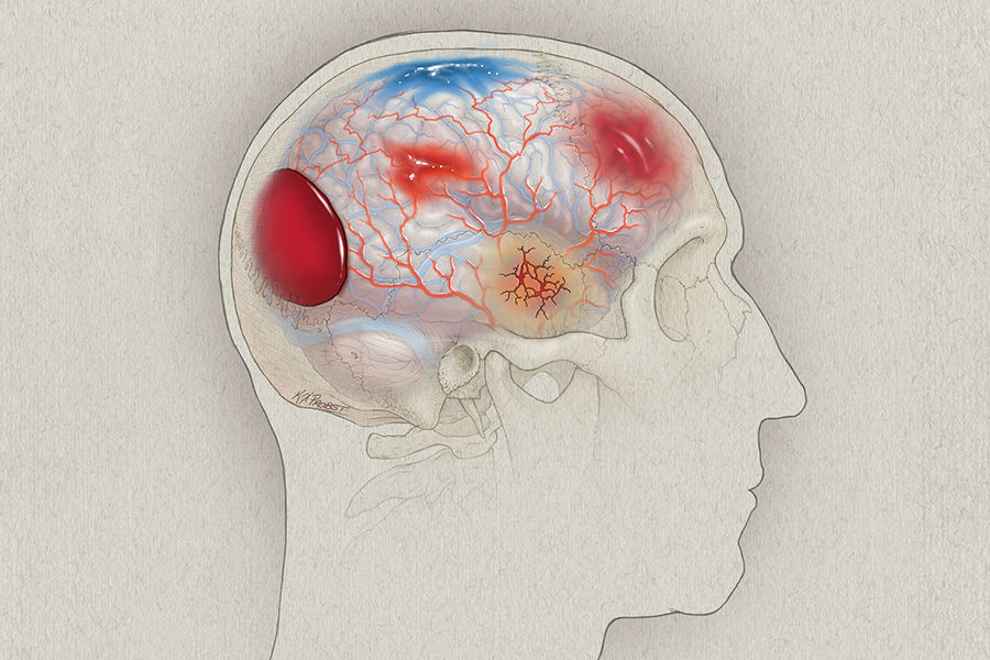 Illustration depicting traumatic brain injuries.