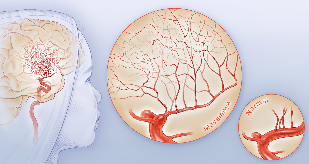 Illustration showing what happens to the blood vessels in the brain in Moyamoya disease