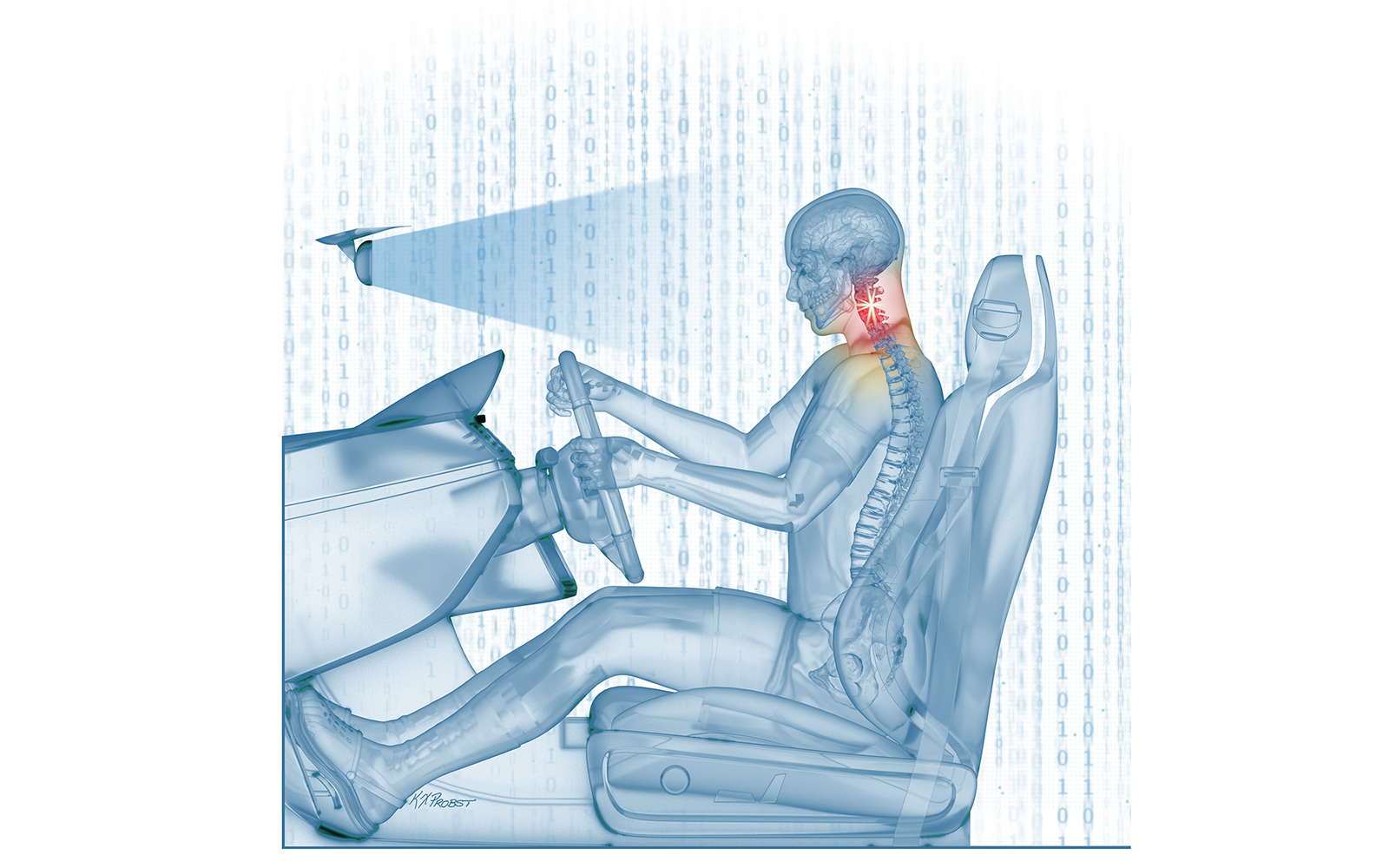 Illustration showing a patient driving after recovery from surgery for cervical spondylotic myelopathy.