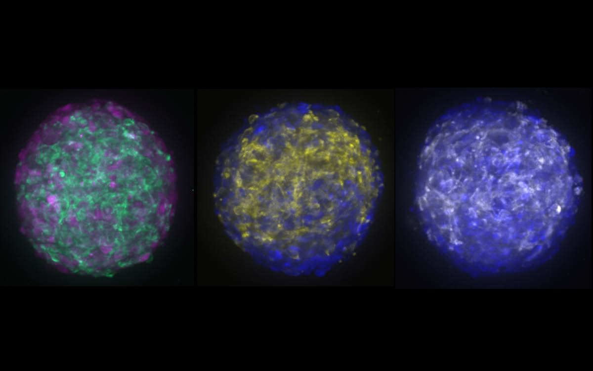 Three meningioma organoids shown side-by-side.