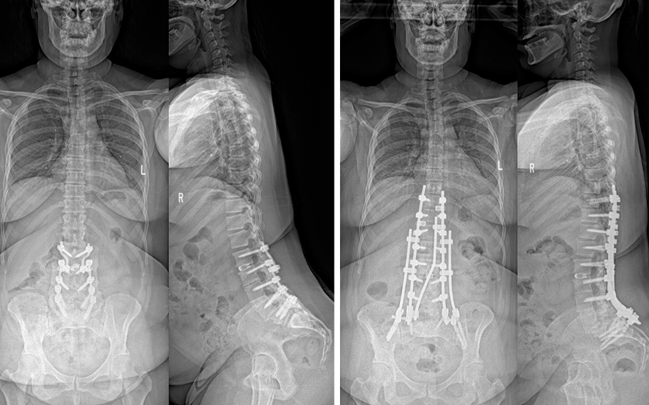 Pre- and post-operative standing radiographs of a patient who underwent pedicle subtraction osteotomy for adult spinal deformity.