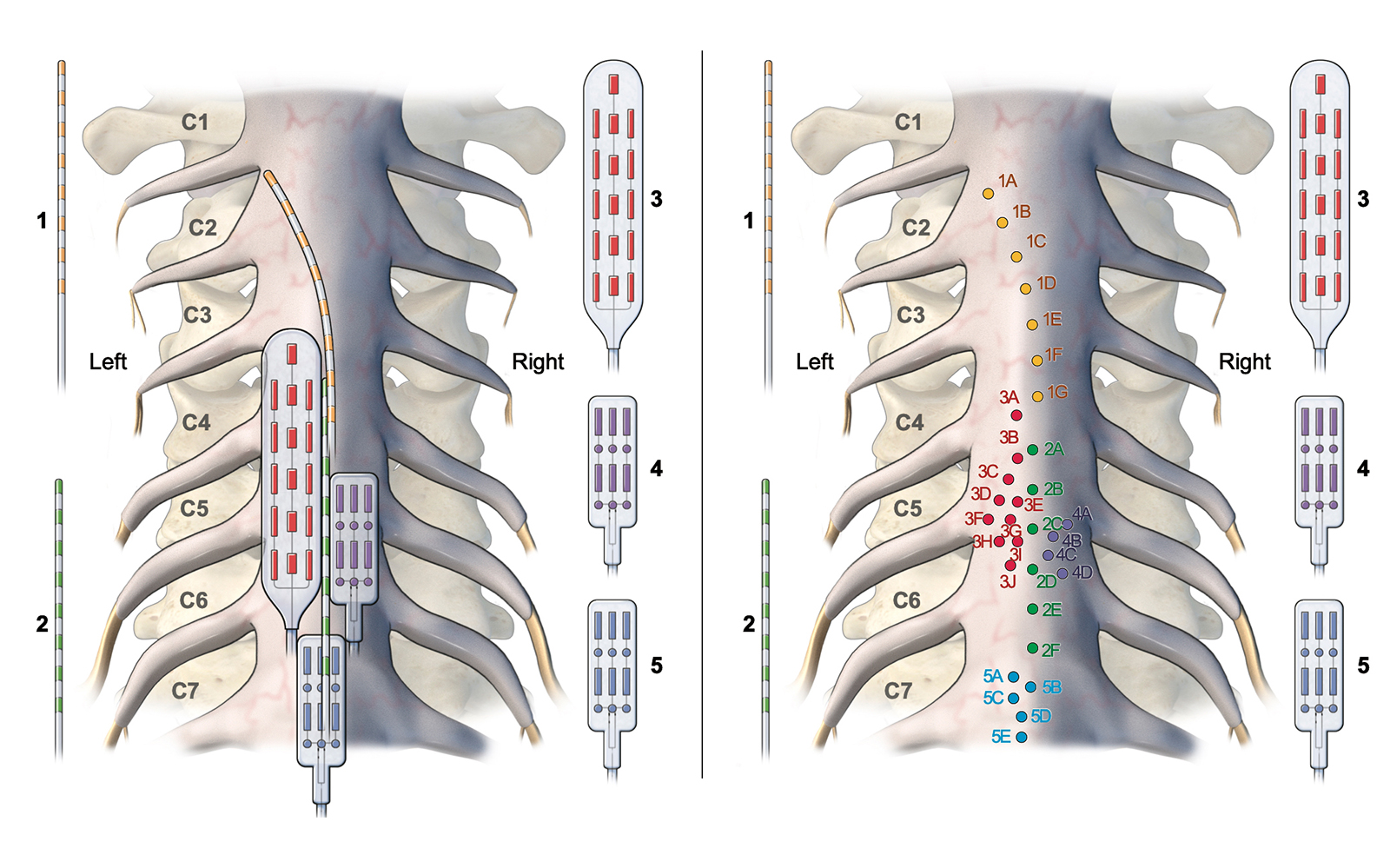 Illustration of the cervical spinal cord showing the position of the epidural electrode leads (left) and a map of all the contacts used in the analysis (right).