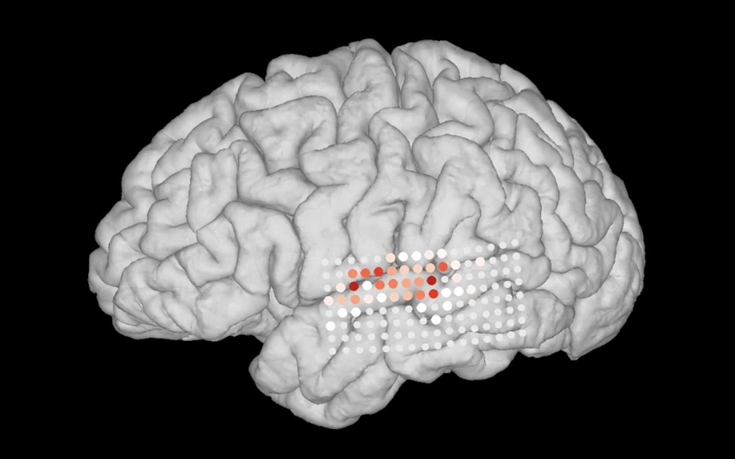 Electrodes show patterns of brain activity in a research participant listening to music.