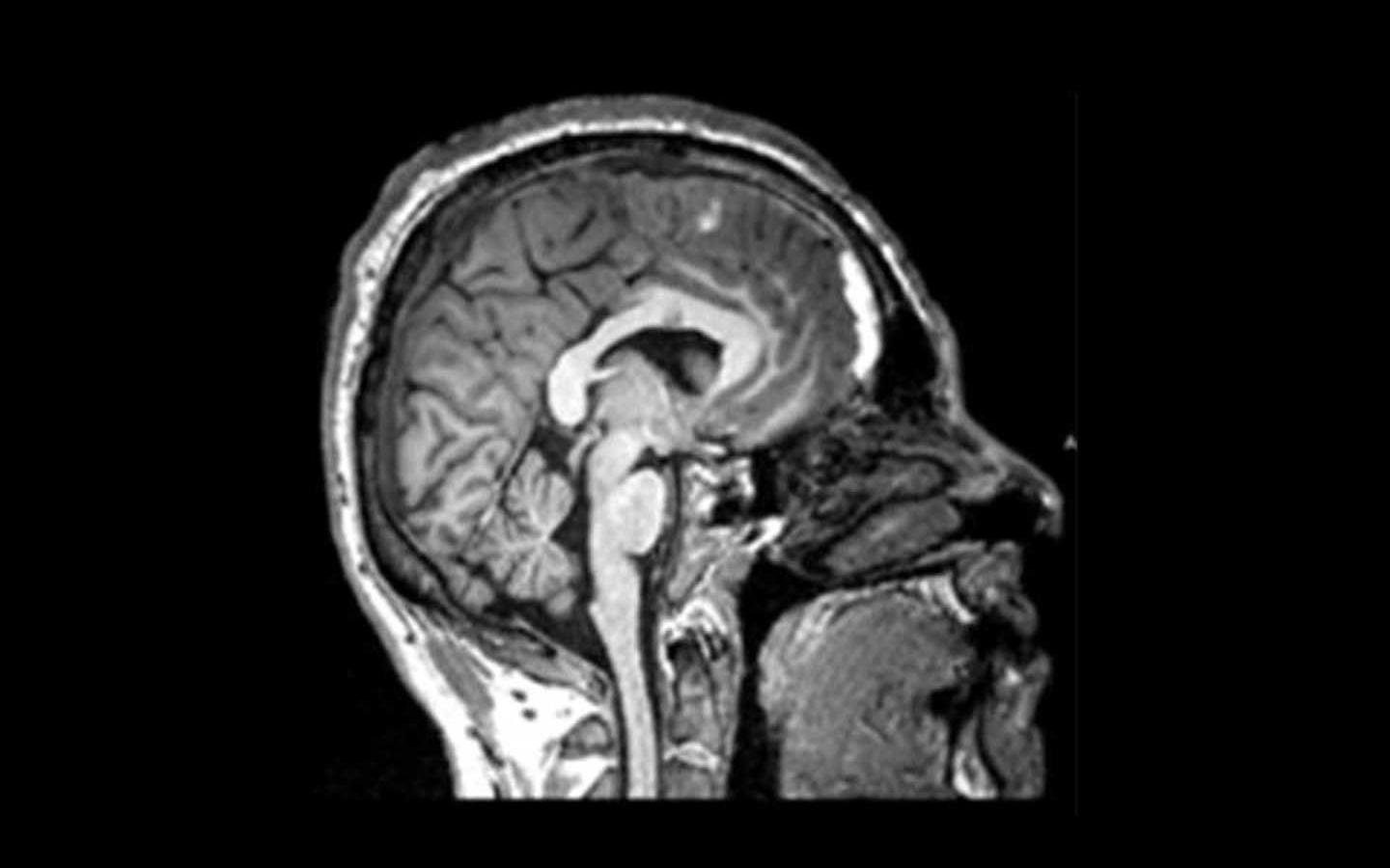 MRI showing a TBI.