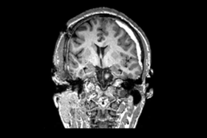 MRI showing a TBI.